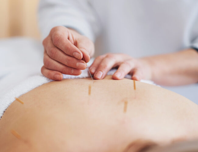 A acupuncture needle therapy in the studio. High quality photo